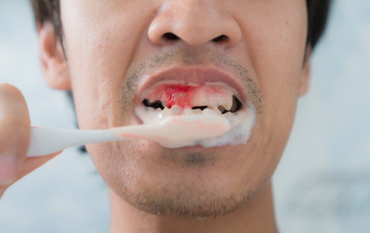 Aggressive Brushing cause Bleeding Gums