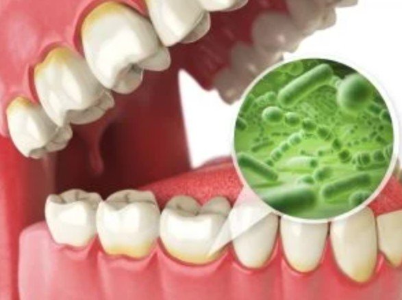 Bacterial Gum Disease