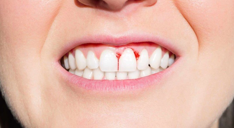 Bleeding Gums and Gum Recession connection