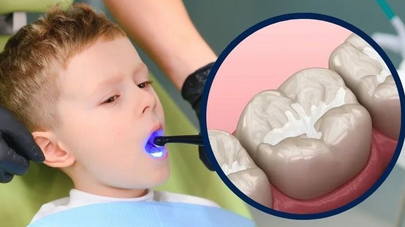 Dental sealants for kids and adolescents