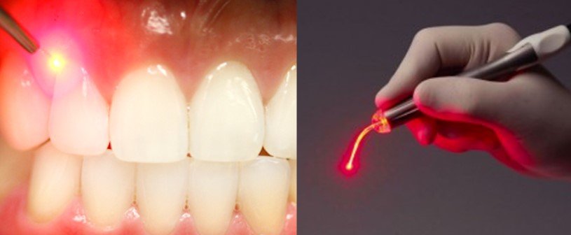 How Red Light Therapy Works for Gum Recession