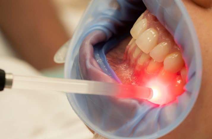 Red Light Therapy Reverse Gum Recession
