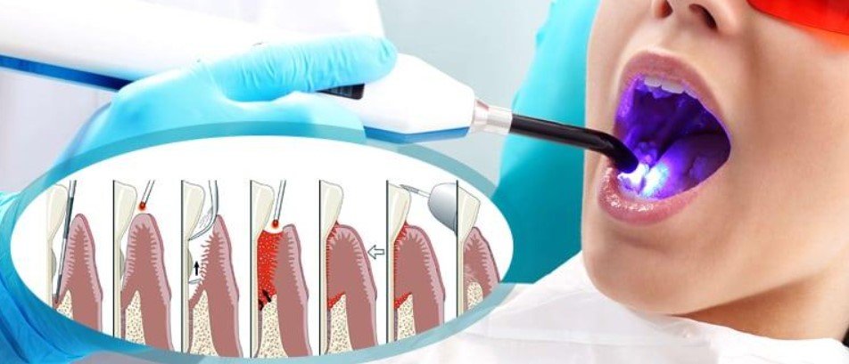 Role of Blue Light Therapy in Gum Health