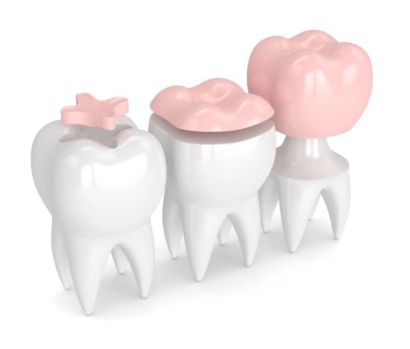 Temporary filling, permanent filling, and crown