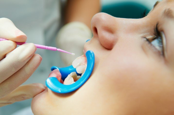 What Do Dental Sealants Do for Teeth and Cavities?