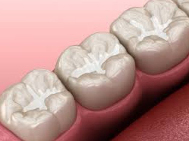 What are dental sealants