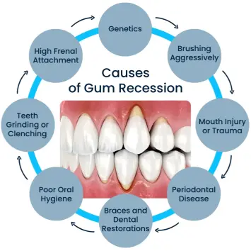 Causes of Gum Recession