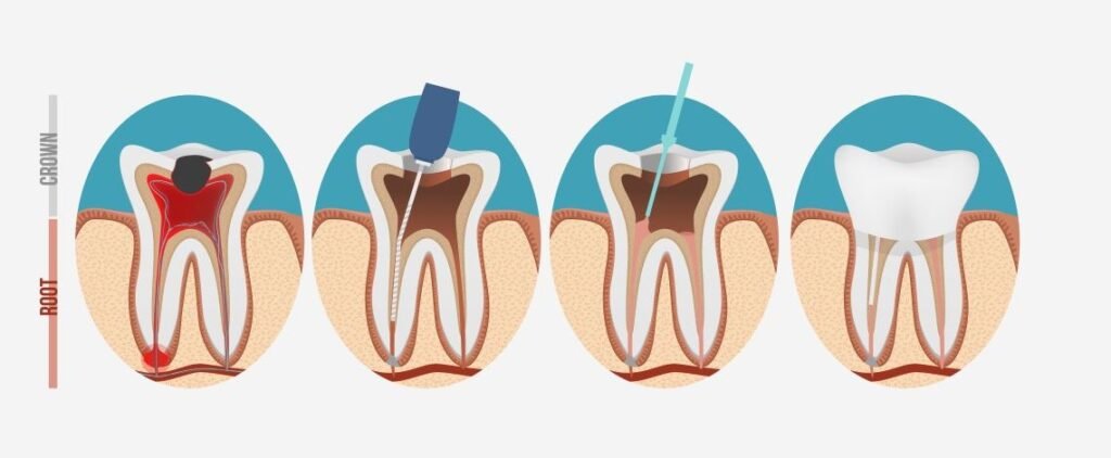 What to expect right after the procedure
